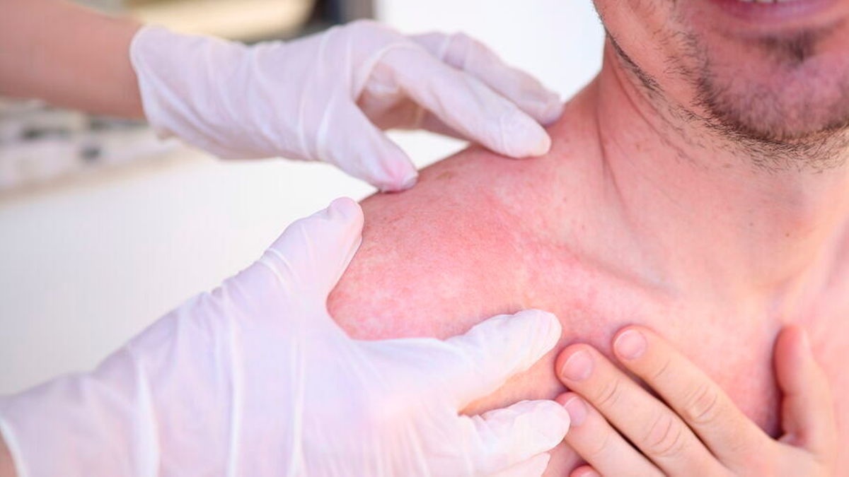Duschpflege und Pflegecreme gegen Radiodermatitis