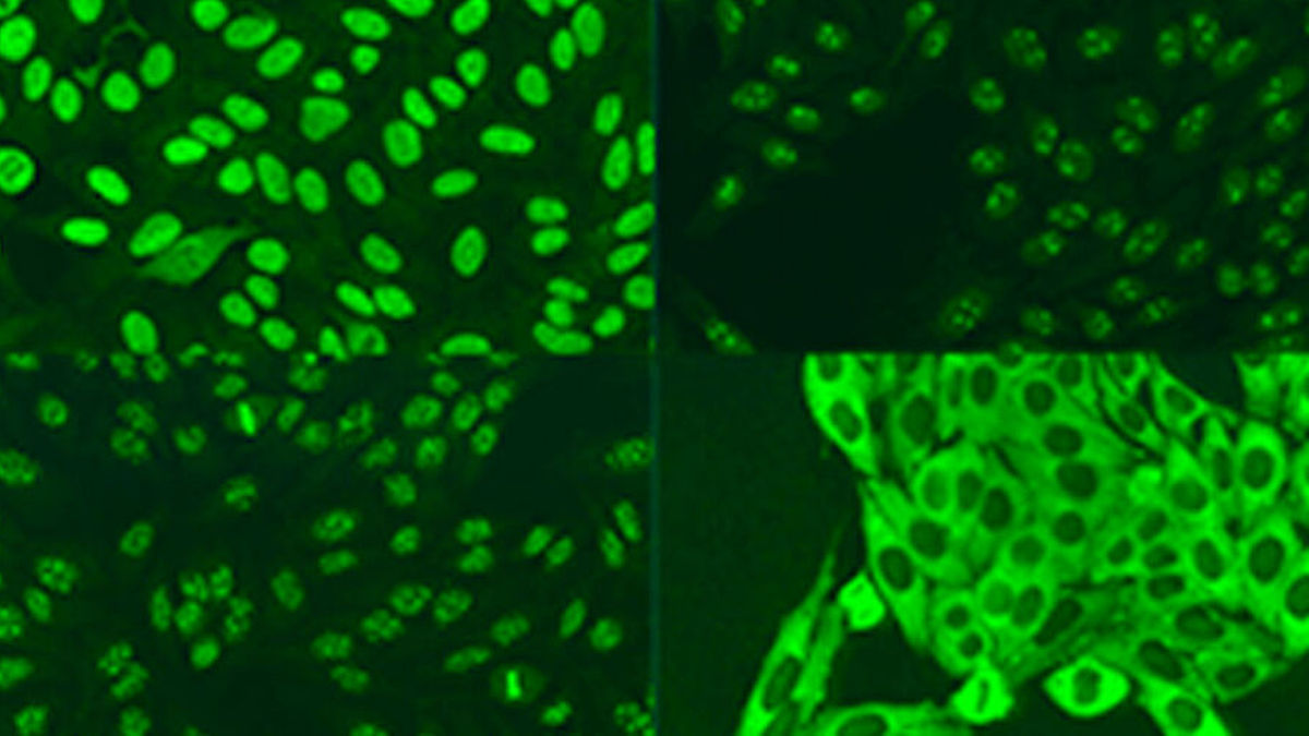 Kollagenosen: Heterogene Autoimmunerkrankungen mit antinukleären ...