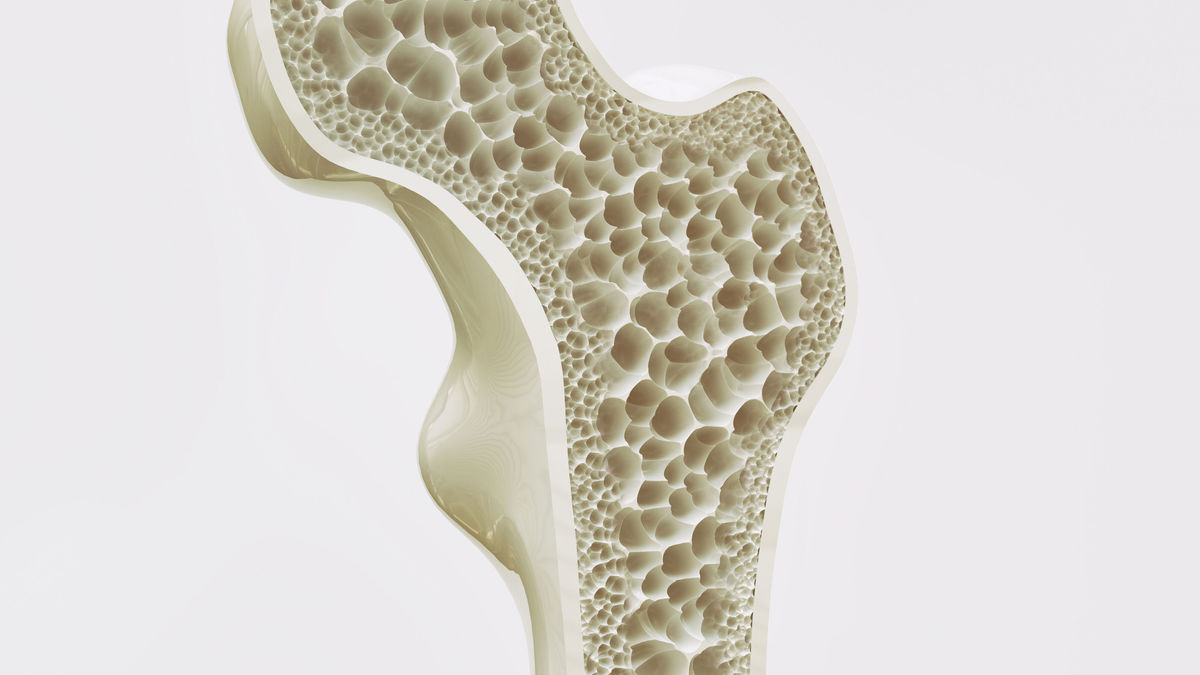 Osteoporose neue real world daten zu romosozumab