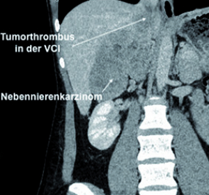 Patientin mit Li-Fraumeni-Syndrom und größenprogredientem Nebennierentumor