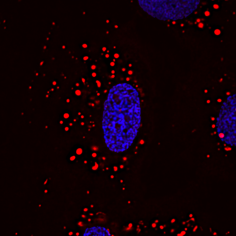 Mikroskopische Aufnahme von Herzzellen von Patienten mit BTHS: blau Zellkern, rot Mitochondrien. Zu sehen ist die defekte punktförmige Ausprägung der Mitochondrien. Mitochondrien haben ihre ursprünglich netzwerkartige Form verloren. Foto: umg