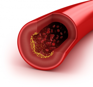 Neue Arteriosklerose-Theorie: Ein Infarkt der Arterienwand führt zu Ablagerungen