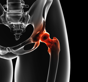 Hüftprothesen: Vermeidung unterschiedlicher Beinlängen durch Baukastensystem