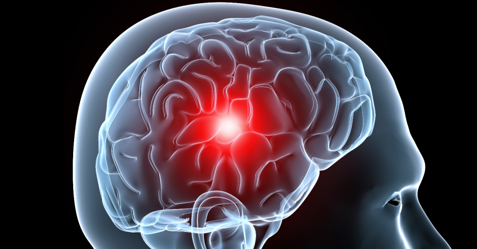 Migräne: Individuelles Therapiemanagement bei chronisch neurologischen Erkrankungen