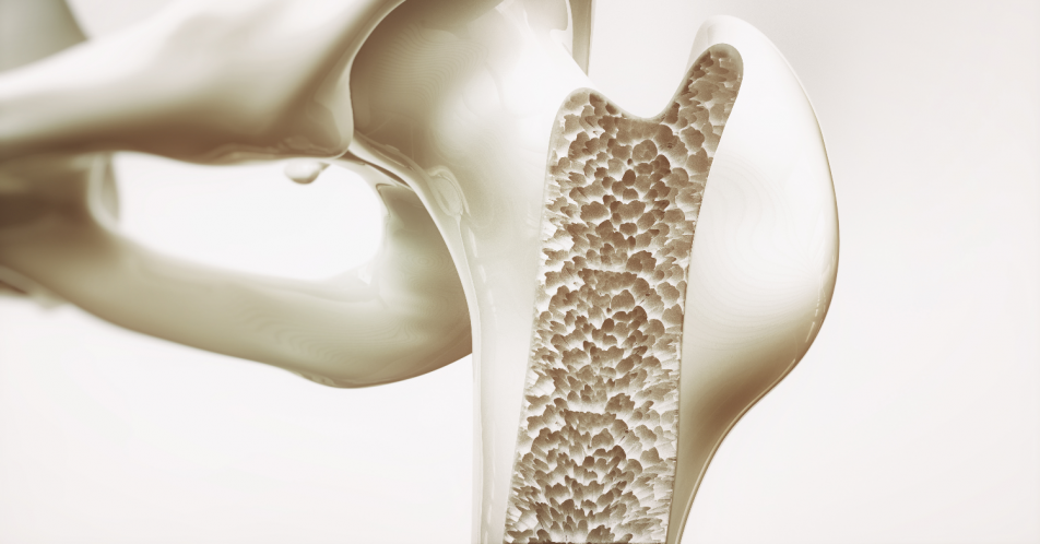 Osteoporose: Zulassung von Romosozumab zur Behandlung von Patientinnen mit erhöhtem Fraktur-Risiko