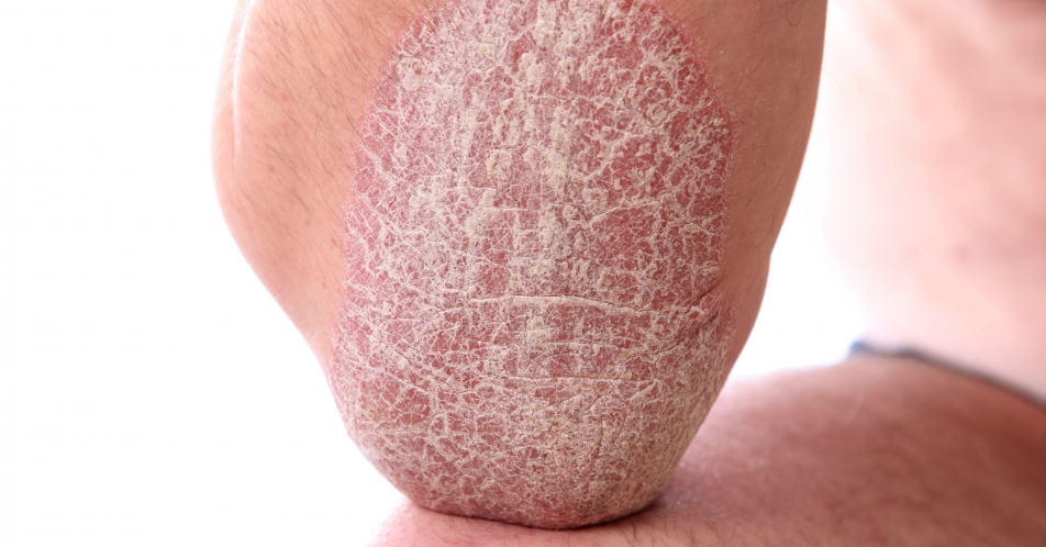 Atopische Dermatitis: Tralokinumab erreicht Endpunkte in zulassungsrelevanten Studien