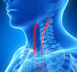 Schlaganfall: Plaques in den Halsschlagadern bei einem Drittel ursächlich