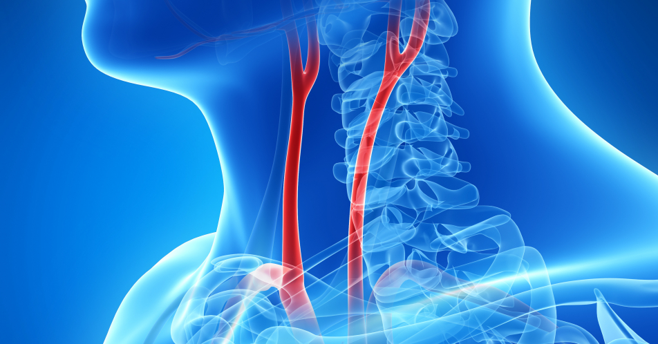 Schlaganfall: Plaques in den Halsschlagadern bei einem Drittel ursächlich