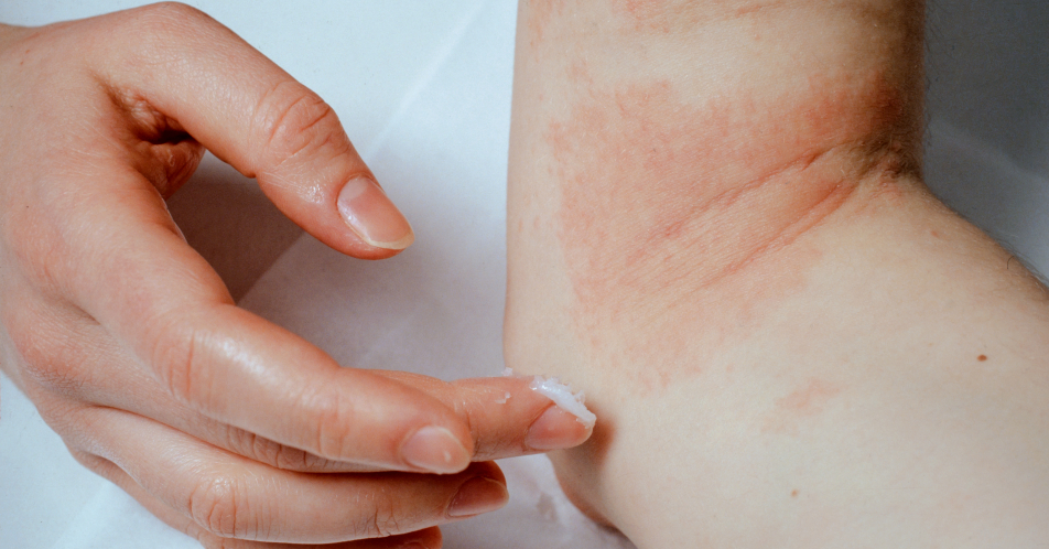 Atopische Dermatitis: Upadacitinib gegenüber Dupilumab überlegen
