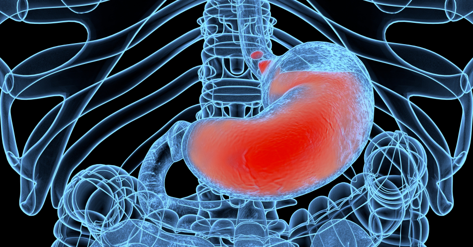 Gastroösophageale Refluxkrankheit – Wenn PPI an ihre Grenzen stoßen