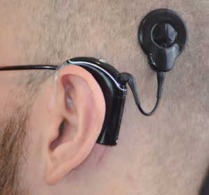 Erstes vollständig implantierbares Cochlea-Implantat (TICI) in Deutschland eingesetzt