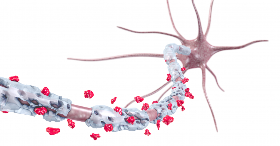 Alzheimer: Prognostischer Bluttest im symptomfreien Zustand
