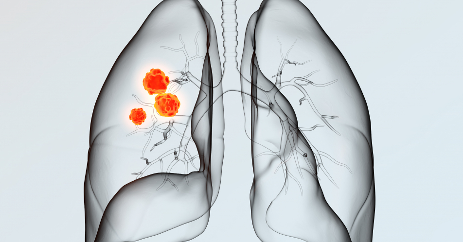 Moderate bis schwere COPD: Exazerbationsrate mit neuer fixen Dreifachtherapie senken