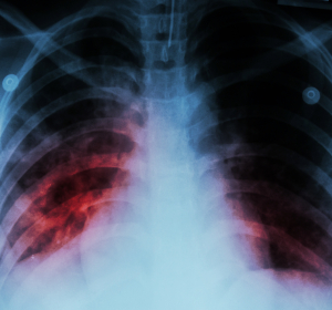 WHO befürchtet viele Tuberkulose-Opfer wegen Corona-Pandemie