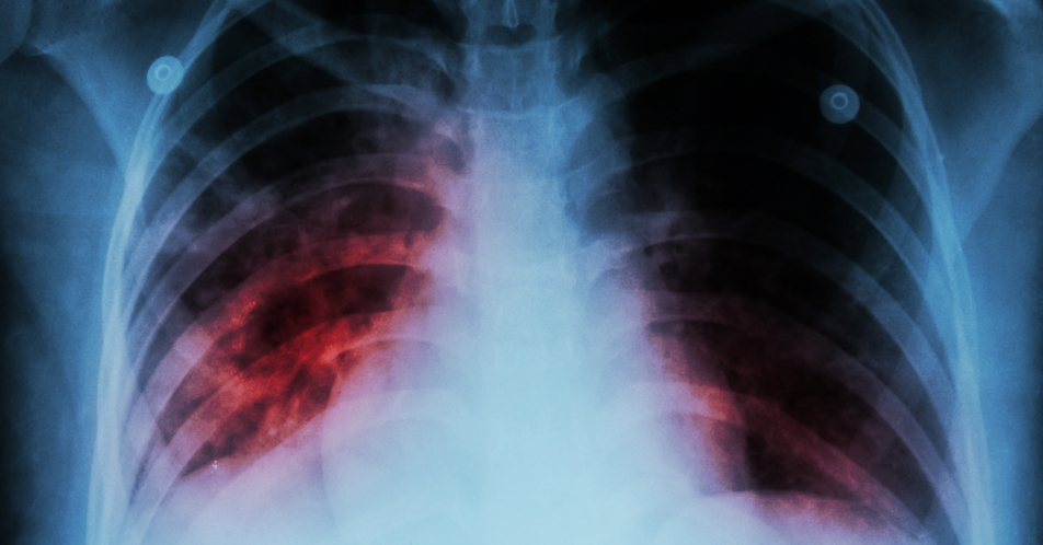 WHO befürchtet viele Tuberkulose-Opfer wegen Corona-Pandemie
