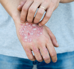 Schwere atopische Dermatitis + Komorbiditäten: Therapie mit Dupilumab