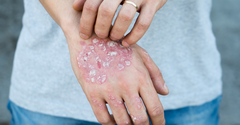 Schwere atopische Dermatitis + Komorbiditäten: Therapie mit Dupilumab