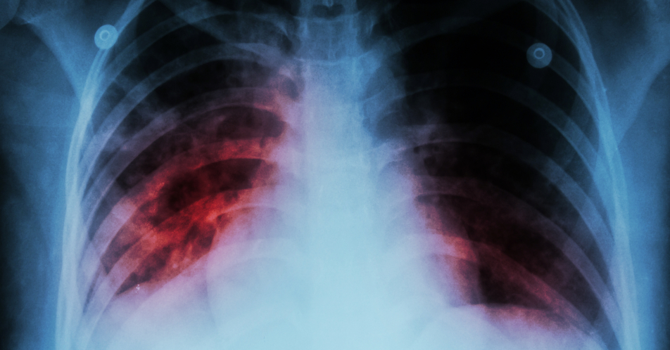 Systemische Sklerose mit Lungenbeteiligung: Weniger Verlust an Lungenfunktion durch Nintedanib