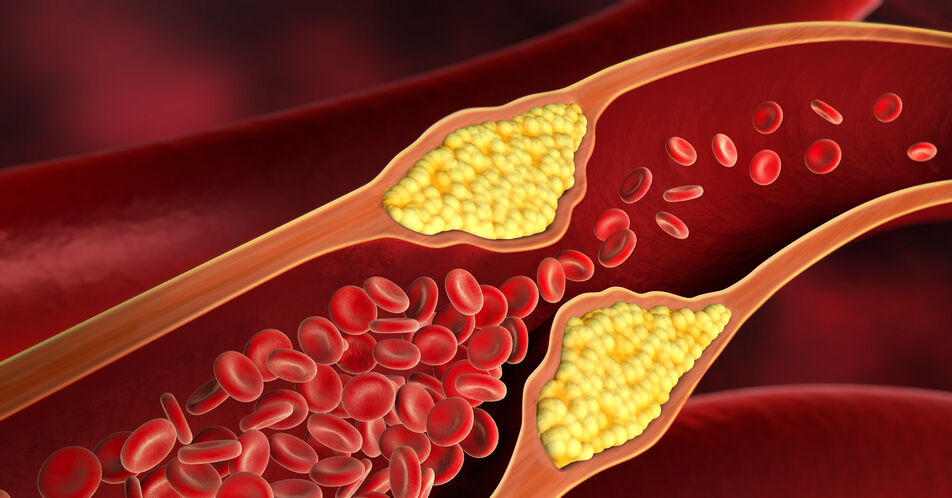 Arteriosklerose: Mechanismen der Immunabwehr gegen Gefäßentzündungen