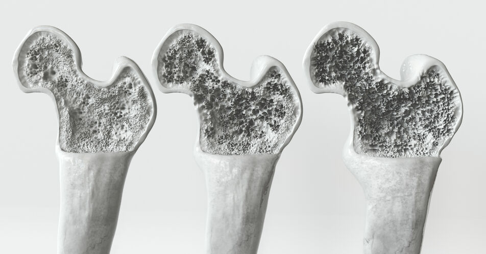 Rheuma: Empfehlung zur Glukokortikoid-induzierten Osteoporose