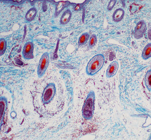 Atopische Dermatitis: Monoklonaler Antikörper neutralisiert gezielt IL-13
