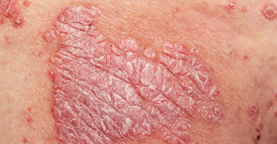 Atopische Dermatitis: Therapieentscheidung anhand der Krankheitsschwere