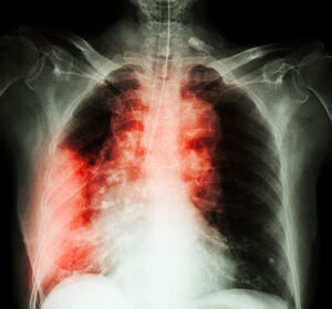 Tuberkulose: Immunitätstypen bestimmen den Krankheitsverlauf