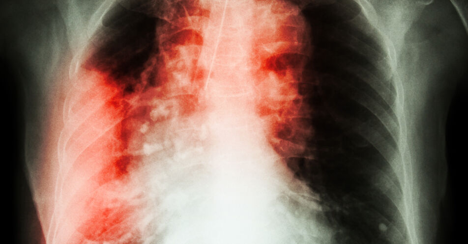 Tuberkulose: Immunitätstypen bestimmen den Krankheitsverlauf