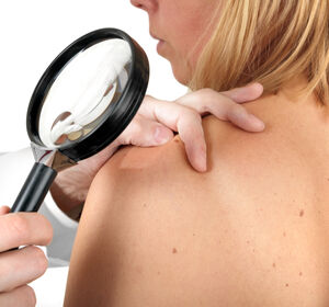 Betriebskrankenkassen erweitern Hautkrebsscreening