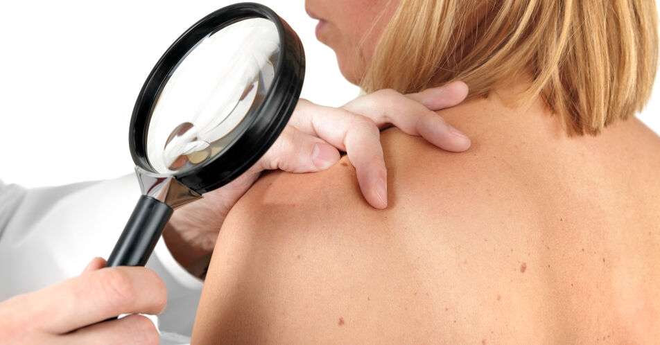 Betriebskrankenkassen erweitern Hautkrebsscreening