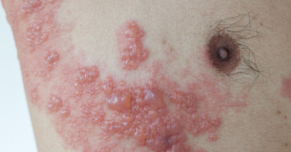 COVID-19-Erkrankung ist ein Risikofaktor für Herpes zoster