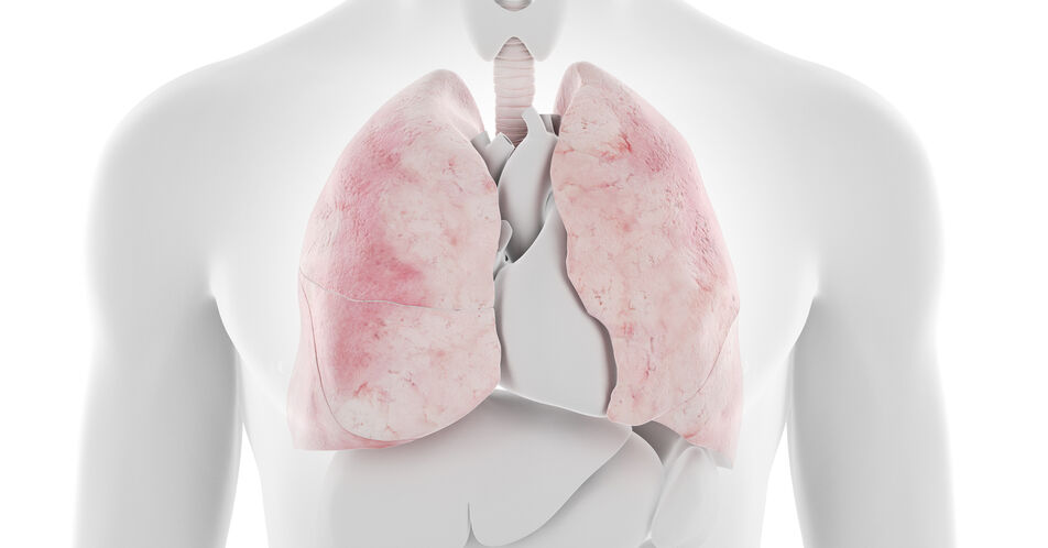 Mehr Lebenszeit bei Lungenfibrosen