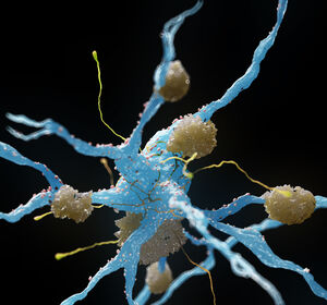 Alzheimer: Positive Studie zu neuem Amyloid-Antikörper Lecanemab – seriöse Einordnung vor Vollpublikation nicht möglich