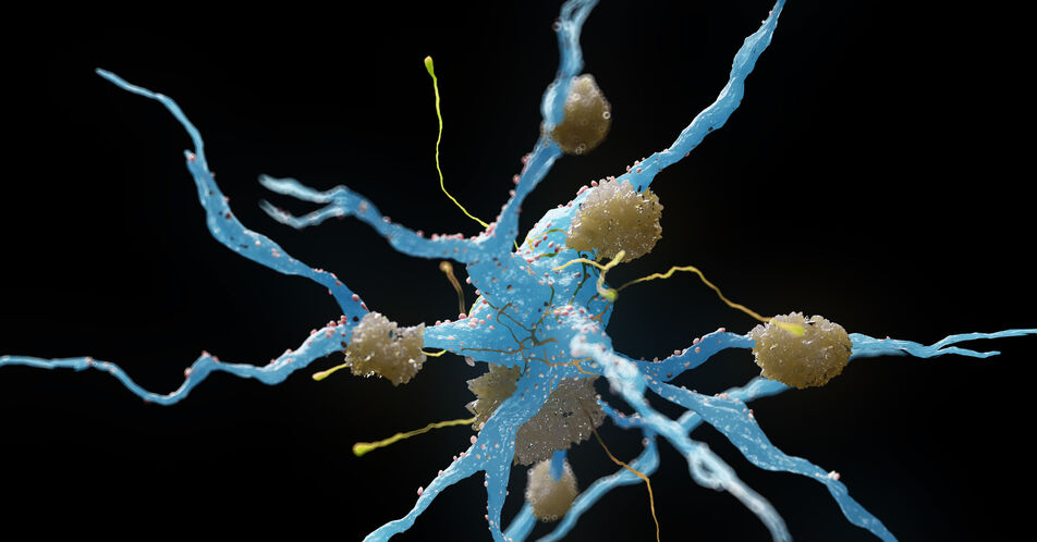 Alzheimer: Positive Studie zu neuem Amyloid-Antikörper Lecanemab – seriöse Einordnung vor Vollpublikation nicht möglich