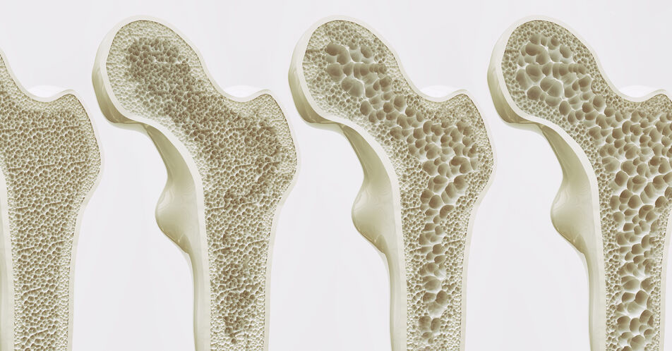 Osteoporose: Neue Kombinationspackung mit Risedronat magensaftresistent und Vitamin D3/Calcium