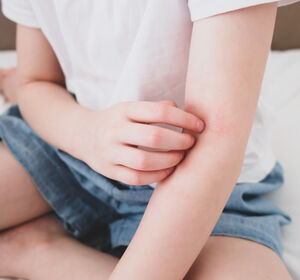 Update atopische Dermatitis: Tipps für die Therapie im Kleinkindes- und Kindesalter