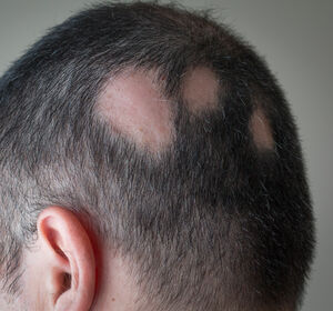 Alopecia areata: Verkannte Autoimmunerkrankung?