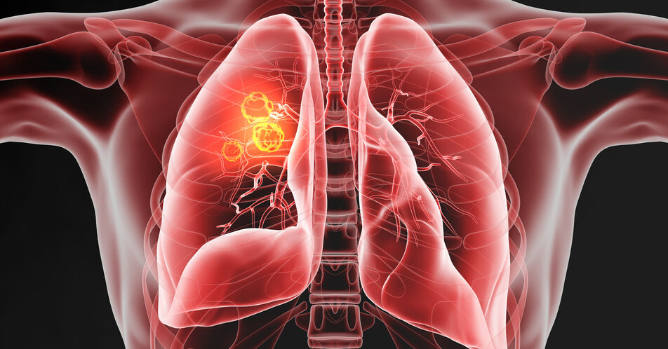 Systemtherapie des nicht-kleinzelligen Lungenkarzinoms