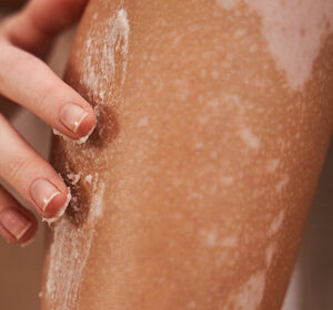 Nur keine Scham – Vitiligo ist kein Lifestyle-Problem