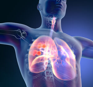 Pneumologen: „Jeder Versicherte sollte Anspruch auf ein Lungenkrebs-Screening haben“