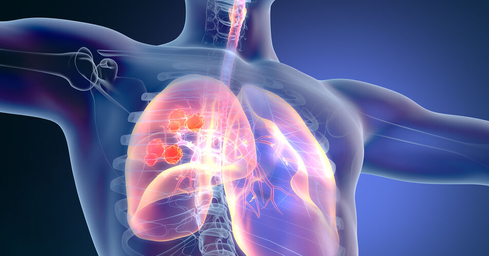 Pneumologen: „Jeder Versicherte sollte Anspruch auf ein Lungenkrebs-Screening haben“