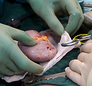 Organtransplantation: Patient:innen in Deutschland profitieren kaum von neuen Möglichkeiten der Präzisionsmedizin