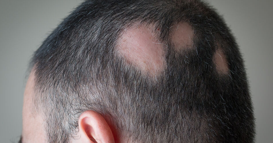 Alopecia areata: Ritlecitinib erhält EU-Zulassung