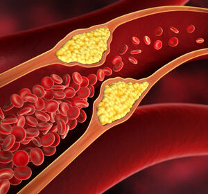 Atherosklerose: Geschlechtsspezifische Unterschiede bei der Entstehung von Plaques