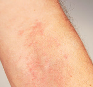 Mittelschwere bis schwere Atopische Dermatitis: Zulassung für Lebrikizumab