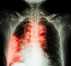 Schwere Lungenentzündung: kurzfristige Cortison-Therapie kann Beatmung und Tod verhindern