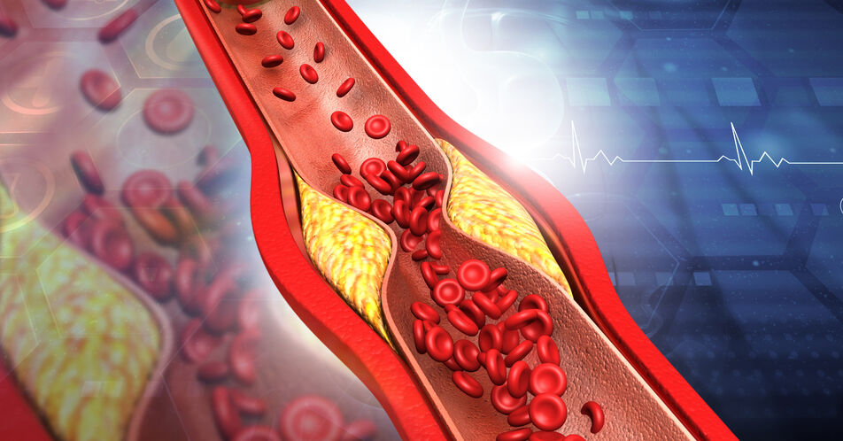 Cholesterin-Senkung hat gesundheitliche und volkswirtschaftliche Vorteile