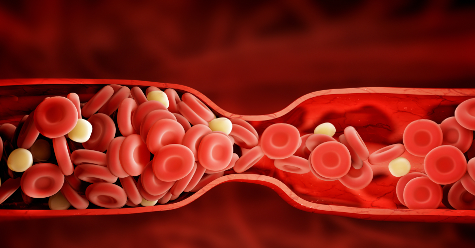 Statine: Warum sind die Cholesterinsenker bei Patienten so unbeliebt?