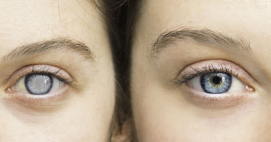Beeinträchtigung der Augen durch Stress – Was kann man tun?