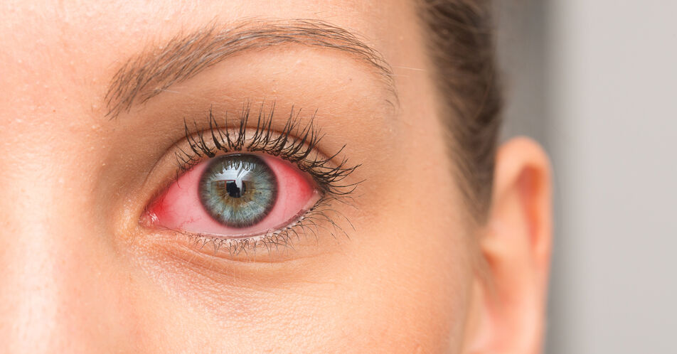 Rote Augen: 5 Warnzeichen, die schnelle Behandlung erfordern
